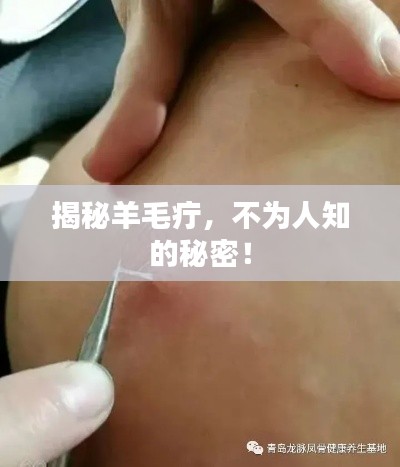 揭秘羊毛疔，不为人知的秘密！